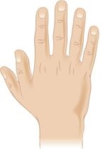 polidactilie preaxială